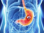Stomach cancer kills, avoid this things immediately to avoid it