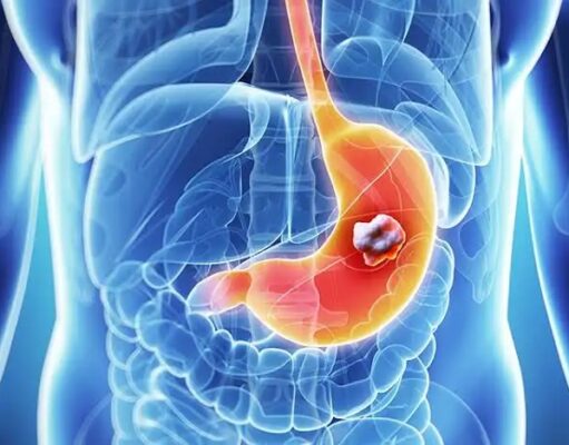Stomach cancer kills, avoid this things immediately to avoid it